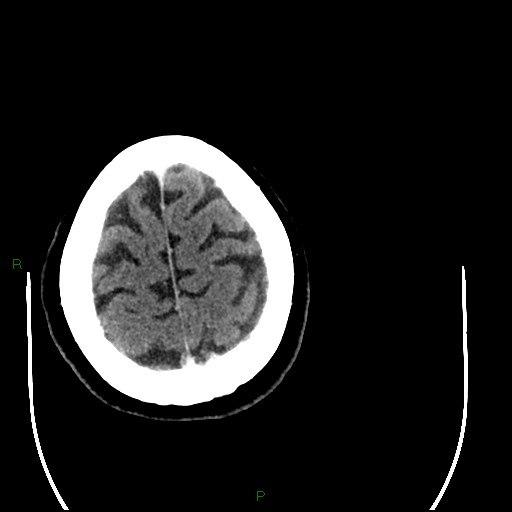 Cerebellar abscess (Radiopaedia 78135-90671 Axial C+ delayed 95).jpg