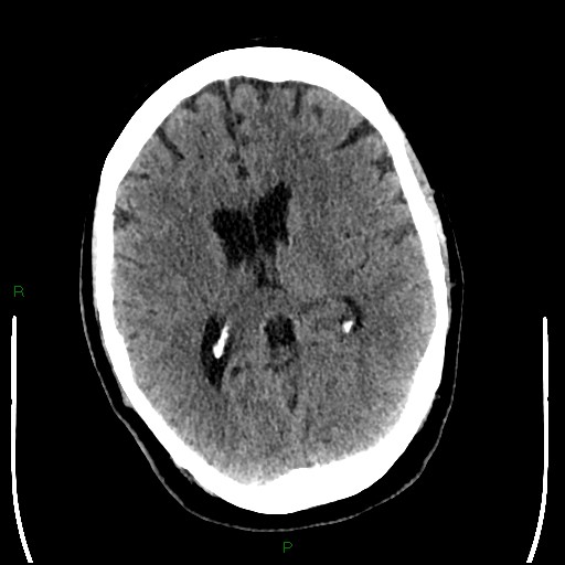 Cerebellar abscess (Radiopaedia 78135-90671 Axial non-contrast 61).jpg