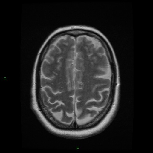 File:Cerebellar abscess (Radiopaedia 78135-90678 Axial T2 23).jpg