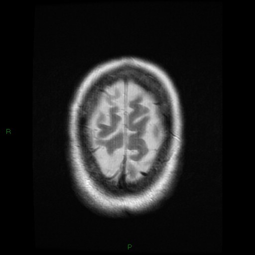 File:Cerebellar abscess (Radiopaedia 78135-90678 Axial T2 27).jpg