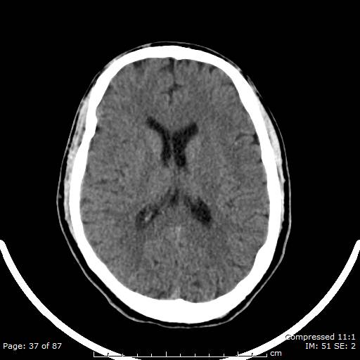 Cerebellar hemangioblastoma (Radiopaedia 52360-58258 Axial non-contrast 37).jpg
