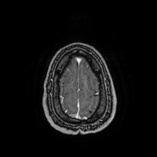 Cerebellar hemangioblastoma (Radiopaedia 88055-104622 Axial T1 C+ 155).jpg