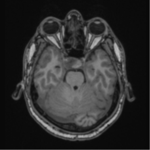 Cerebellar hemangioblastomas and pituitary adenoma (Radiopaedia 85490-101176 Axial T1 25).png