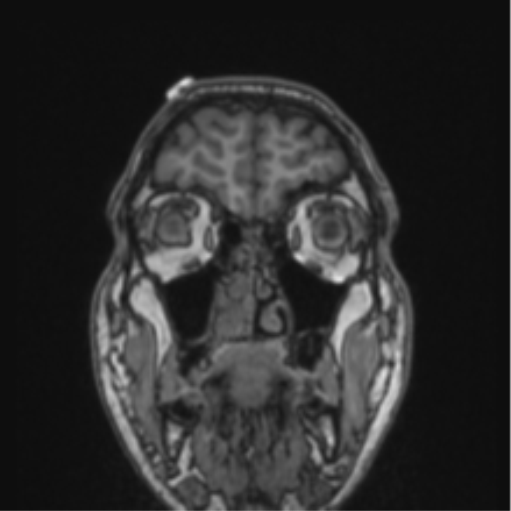 File:Cerebellar hemangioblastomas and pituitary adenoma (Radiopaedia 85490-101176 Coronal T1 77).png