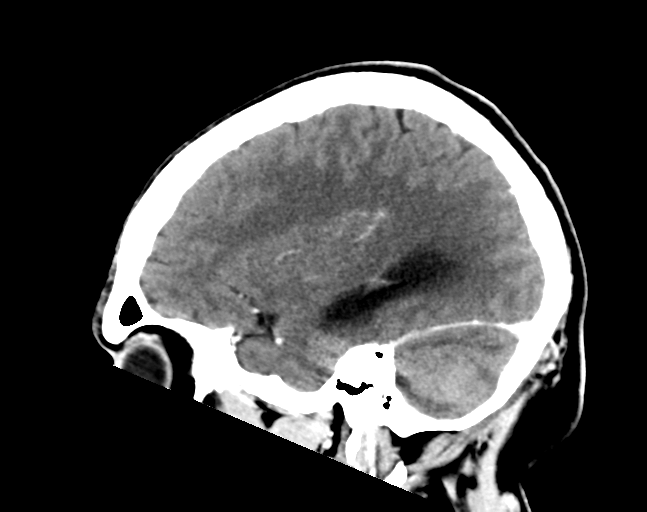 File:Cerebellar hemorrhage (Radiopaedia 37000-38671 Sagittal C+ 11).png