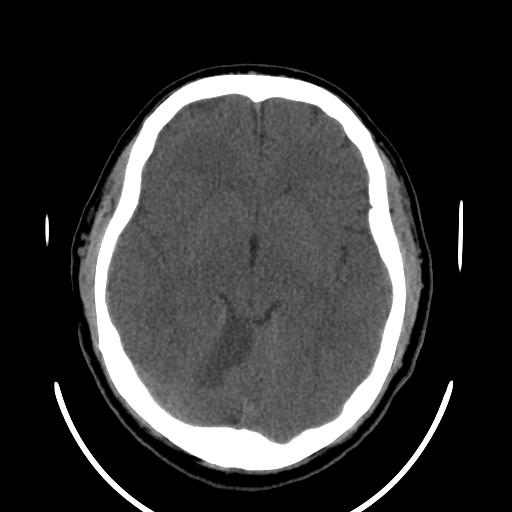File:Cerebellar infarction (Radiopaedia 16625-16327 Axial non-contrast 18).jpg