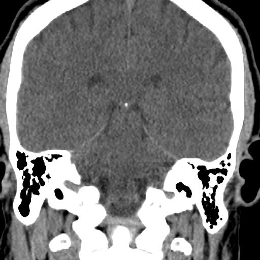 Cerebellar infarction (Radiopaedia 16625-16327 Coronal non-contrast 18).jpg