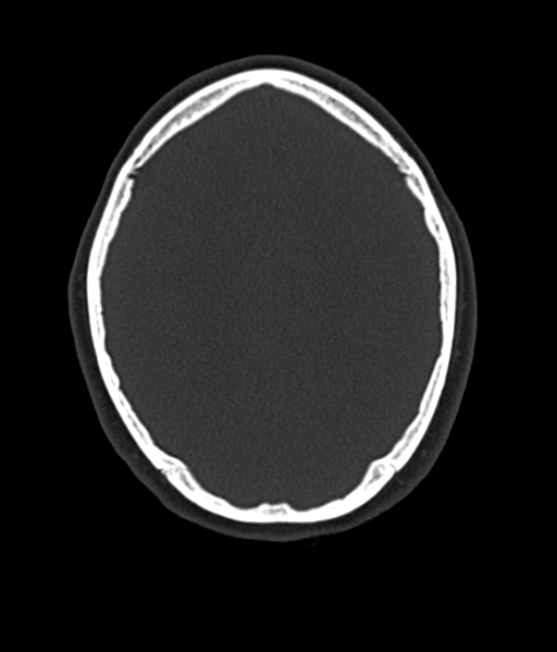 Cerebellar metastases - colorectal adenocarcinoma (Radiopaedia 40947-43652 AX Bone C- 2.0 MPR 46).png