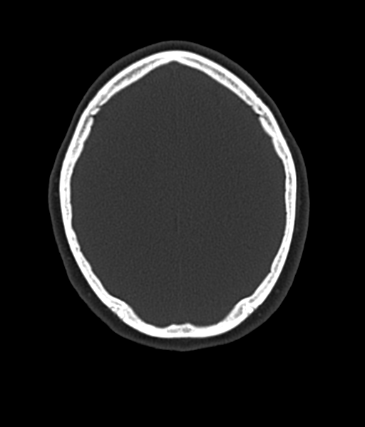Cerebellar metastases - colorectal adenocarcinoma (Radiopaedia 40947-43652 AX Bone C- 2.0 MPR 48).png