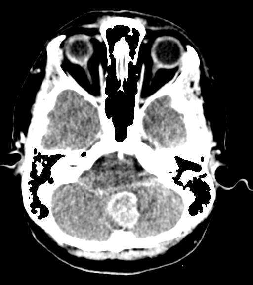 Cerebellar metastases - colorectal adenocarcinoma (Radiopaedia 40947-43652 Axial C+ 10).png