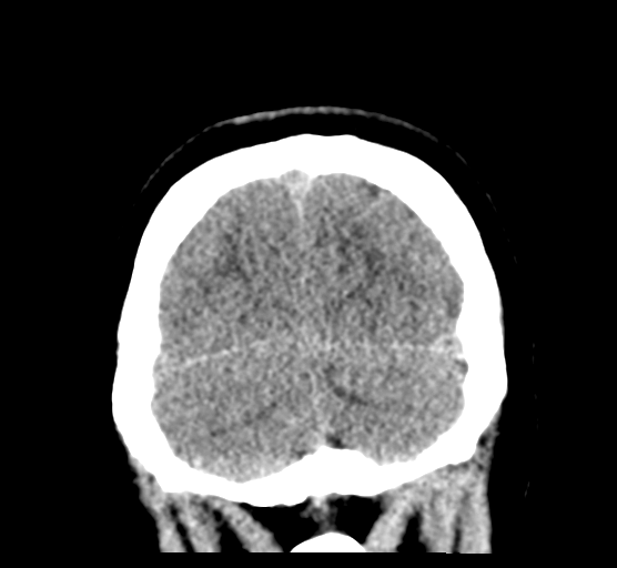 Cerebellar metastases - colorectal adenocarcinoma (Radiopaedia 40947-43652 Coronal non-contrast 82).png