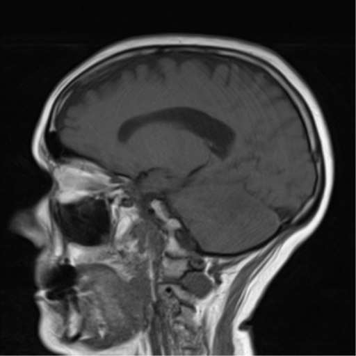 File:Cerebellar metastasis (Radiopaedia 54578-60810 Sagittal T1 8).png