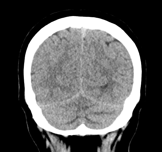 Cerebellar metastasis (Radiopaedia 54578-60812 Coronal non-contrast 49).png