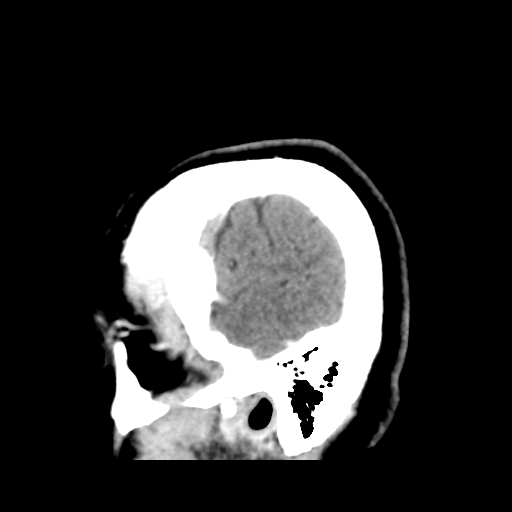 Cerebellar metastasis (cystic appearance) (Radiopaedia 41395-44258 F 8).png