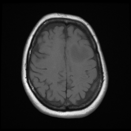 File:Cerebellar metastasis (cystic appearance) (Radiopaedia 41395-44268 Axial T1 18).png