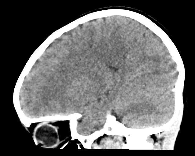 File:Cerebellar stroke (Radiopaedia 32202-33149 B 21).png