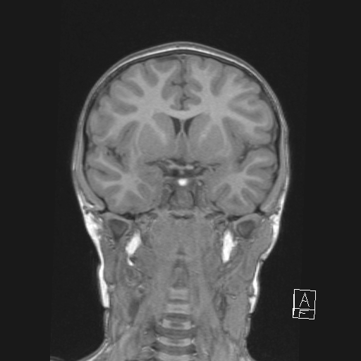 Cerebellar stroke (Radiopaedia 32202-33150 Coronal T1 25).png