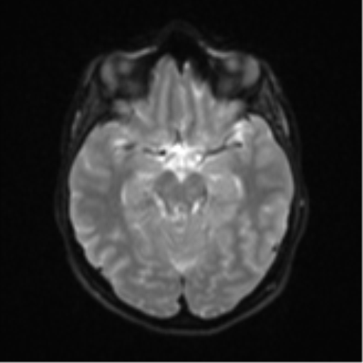 Cerebellar tuberculomas (Radiopaedia 46939-51472 Axial DWI 12).png