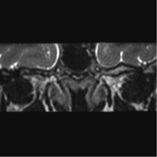 Cerebellopontine angle meningioma (Radiopaedia 48434-53348 Coronal T2 80).png