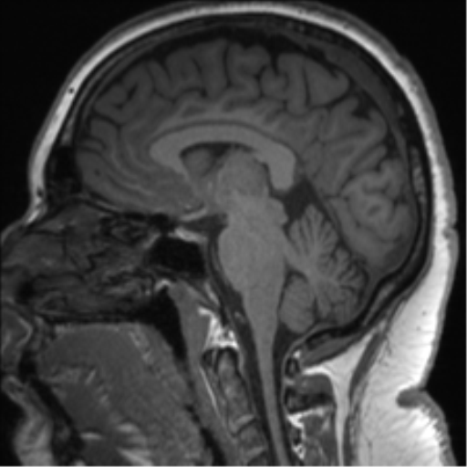 Cerebellopontine angle meningioma (Radiopaedia 48434-53348 Sagittal T1 45).png