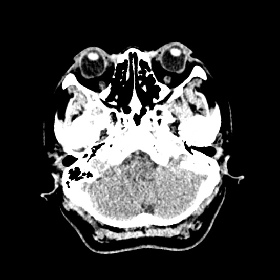 File:Cerebellopontine angle meningioma (Radiopaedia 53561-59592 Axial non-contrast 12).jpg