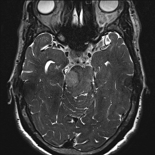 Cerebellopontine angle meningioma (Radiopaedia 72983-83680 Axial FIESTA 59).jpg