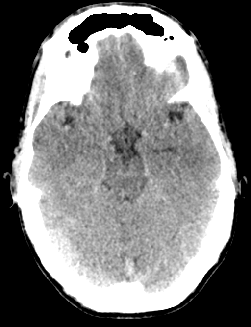 Cerebral abscess (Radiopaedia 60342-68008 Axial non-contrast 19).png