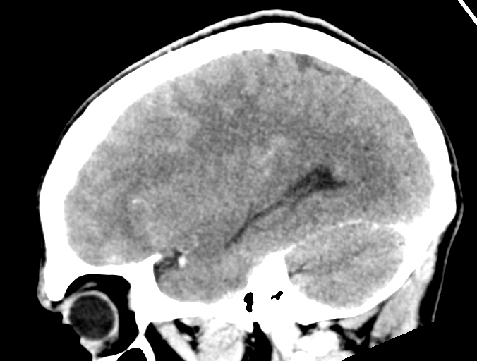 Cerebral abscess (Radiopaedia 60342-68008 Sagittal C+ delayed 15).png