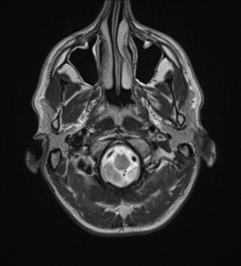 File:Cerebral abscess (Radiopaedia 60342-68009 Axial T2 1).png