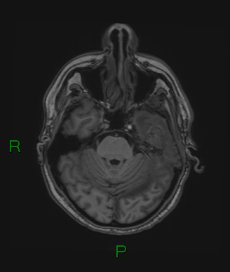 Cerebral abscess and subdural empyema (Radiopaedia 84436-99779 Axial T1 61).jpg