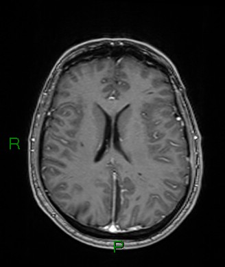 Cerebral abscess and subdural empyema (Radiopaedia 84436-99779 Axial T1 C+ 36).jpg