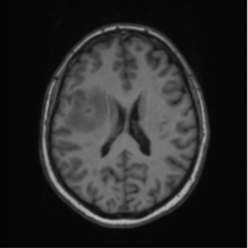 File:Cerebral abscess from pulmonary arteriovenous malformation (Radiopaedia 86275-102291 Axial T1 46).png