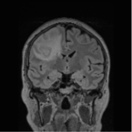 Cerebral abscess from pulmonary arteriovenous malformation (Radiopaedia 86275-102291 Coronal FLAIR 50).png