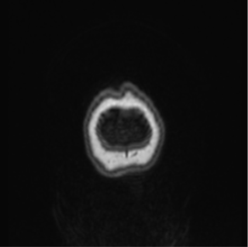 File:Cerebral abscess from pulmonary arteriovenous malformation (Radiopaedia 86275-102291 Coronal T1 4).png