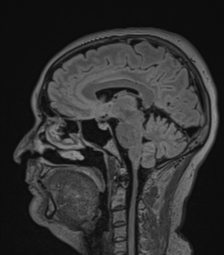 Cerebral abscess from pulmonary arteriovenous malformation (Radiopaedia 86275-102291 Sagittal FLAIR 35).png