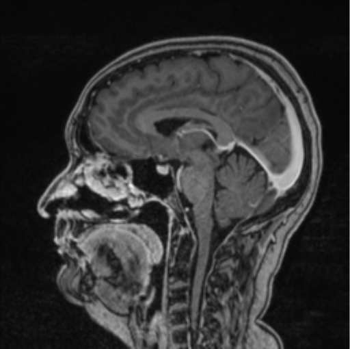 Cerebral abscess from pulmonary arteriovenous malformation (Radiopaedia 86275-102291 Sagittal T1 C+ 38).png