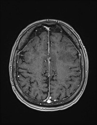 Cerebral amyloid angiopathy-related inflammation (Radiopaedia 58270-65377 Axial T1 C+ fat sat 107).jpg