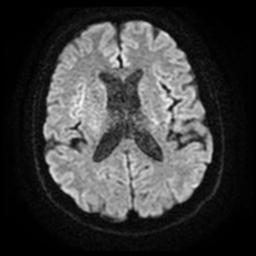 Cerebral amyloid angiopathy (Radiopaedia 28698-28978 Axial DWI 17).jpg