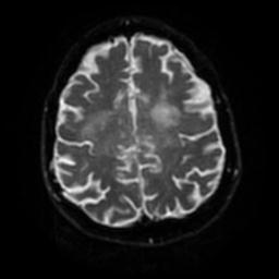 Cerebral amyloid angiopathy (Radiopaedia 28698-28978 Axial DWI 50).jpg