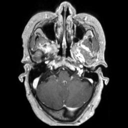 Cerebral amyloid angiopathy (Radiopaedia 29129-29518 Axial T1 C+ 34).jpg