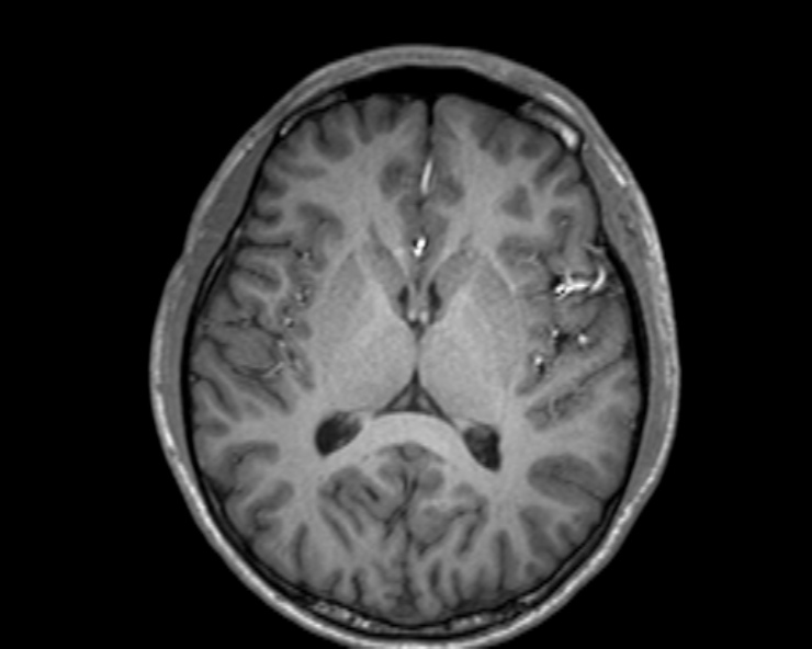 Cerebral arteriovenous malformation (Radiopaedia 30198-30813 Axial T1 32).jpg