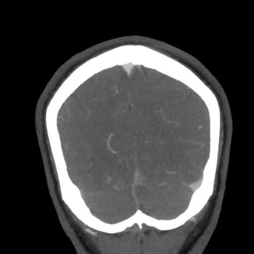 Cerebral arteriovenous malformation (Radiopaedia 39259-41505 E 58).png