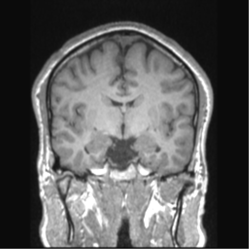 File:Cerebral arteriovenous malformation (Radiopaedia 39259-41506 Coronal T1 51).png