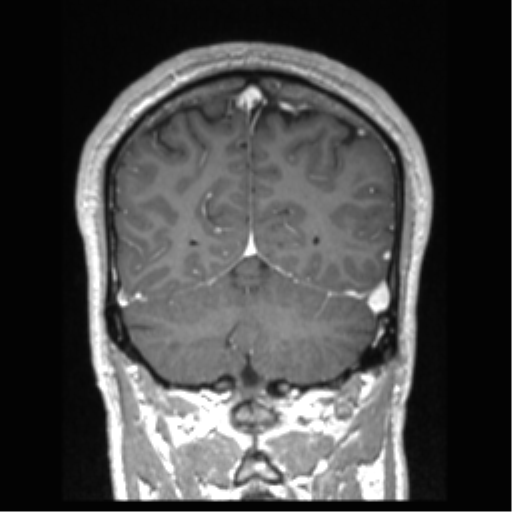 Cerebral arteriovenous malformation (Radiopaedia 39259-41506 Coronal T1 C+ 26).png