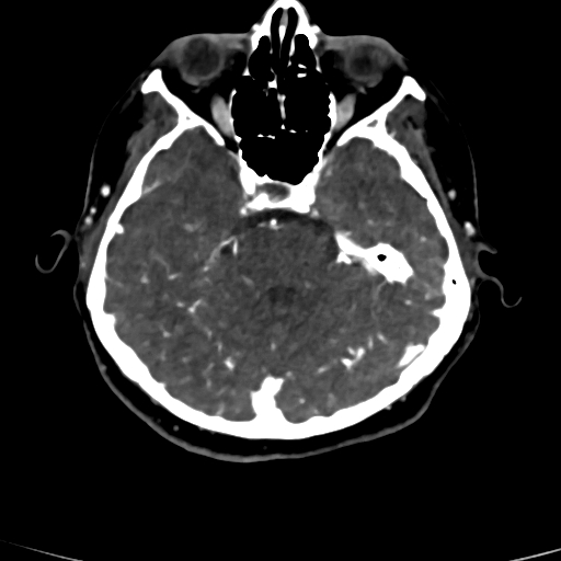 Cerebral arteriovenous malformation (Radiopaedia 73830-84645 Axial C+ delayed 65).jpg