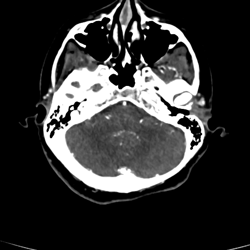 Cerebral arteriovenous malformation (Radiopaedia 73830-84645 Axial C+ delayed 73).jpg