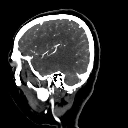 Cerebral arteriovenous malformation (Radiopaedia 73830-84645 Sagittal C+ delayed 19).jpg