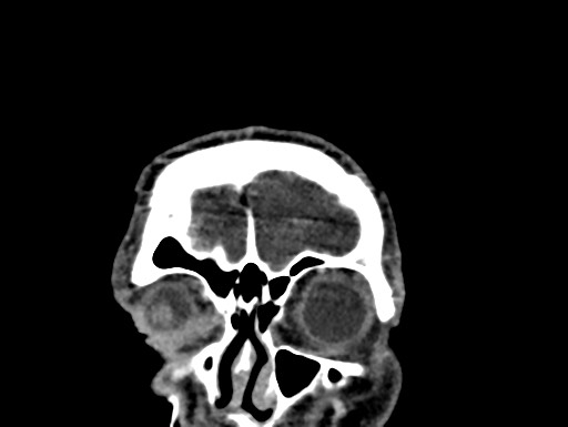 Cerebral arteriovenous malformation (Radiopaedia 78188-90746 Coronal C+ delayed 2).jpg