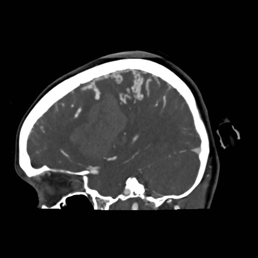 File:Cerebral arteriovenous malformation (Radiopaedia 79677-92888 C 10).jpg