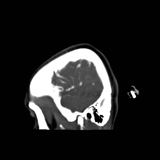 File:Cerebral arteriovenous malformation (Radiopaedia 79677-92888 C 2).jpg